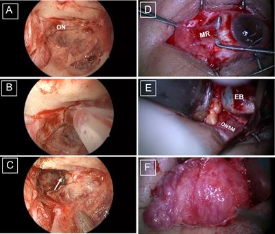 Combined endoscopic transethmoid and transconjunctival en bloc resection of optic nerve tumors in patients lacking functional vision